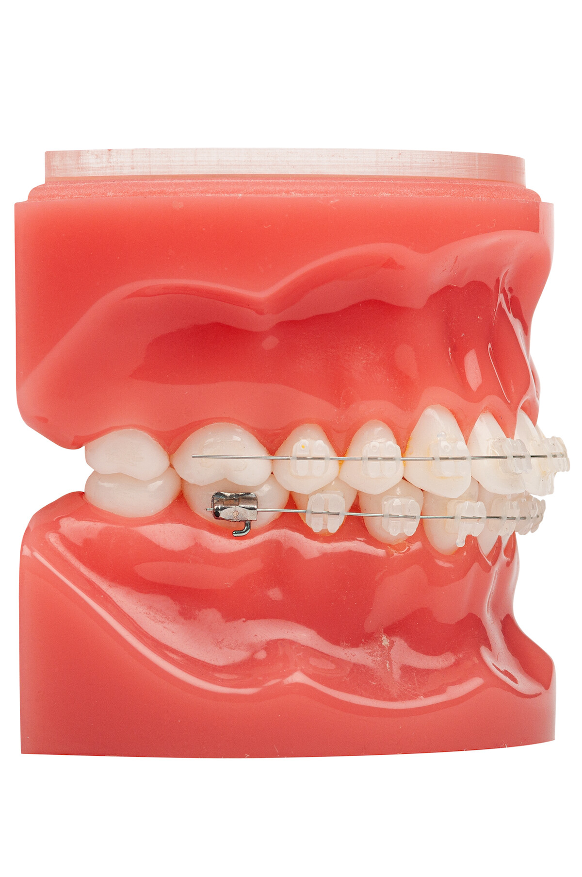 Orthodontist Diemen keramische brackets