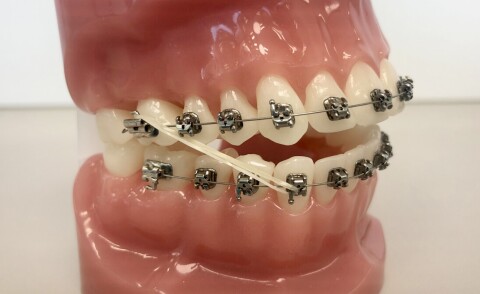 Orthodontie Amsterdam klasse 3 elastiekjes