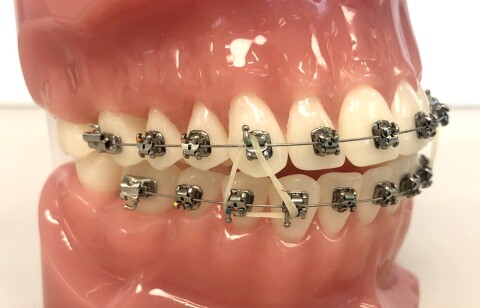 Orthodontie Amsterdam  kleine driehoek elastiekjes