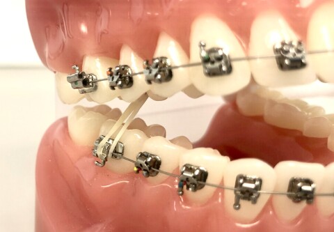 Orthodontie Amsterdam  Kruisbeetelastiek jpeg