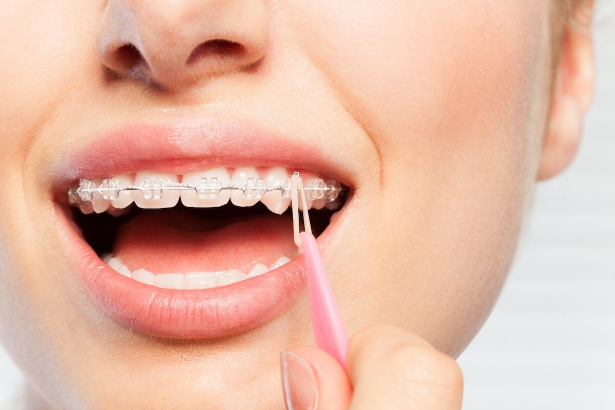 Orthodontist Amsterdam Elastiekjes gebruiksaanwijzing