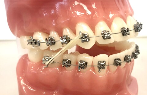 Orthodontist Amsterdam klasse 2 elastiekjes