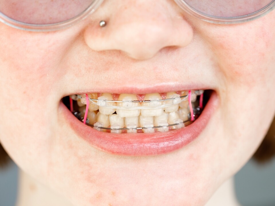 Orthodontist amsterdam orthodontie elastiekjes